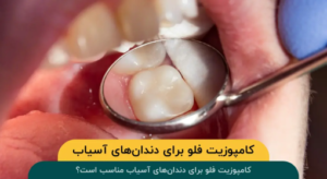 کامپوزیت فلو برای دندانهای آسیاب مناسب است؟
