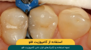 نحوه استفاده و تکنیکهای قرار دادن کامپوزیت فلو در دندانپزشکی