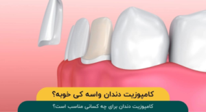 کامپوزیت دندان برای چه کسانی مناسب است؟