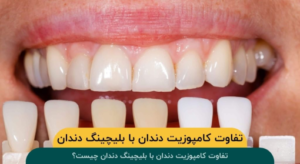 تفاوت کامپوزیت دندان با بلیچینگ دندان