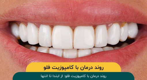 روند درمان با کامپوزیت فلو: از ابتدا تا انتها