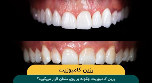 رزین کامپوزیت چگونه بر روی دندان قرار می‌گیرد؟