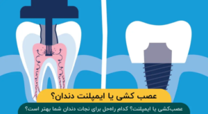 عصب کشی یا ایمپلنت دندان؟ کدام روش مناسبتر است؟