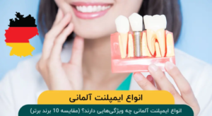 انواع ایمپلنت آلمانی چه ویژگیهایی دارند؟ (مقایسه 10 برند برتر)