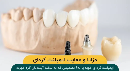 مزایا و معایب ایمپلنت کره‌ای: راهنمای جامع انتخاب بهترین برند + مقایسه با انواع دیگر