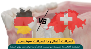 تفاوت ایمپلنت آلمانی با ایمپلنت سوئیسی