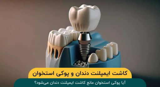 آیا با وجود پوکی استخوان می‌توان ایمپلنت دندان کاشت؟