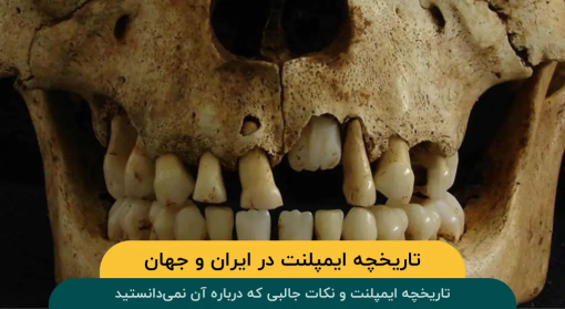 تاریخچه ایمپلنت در ایران و جهان