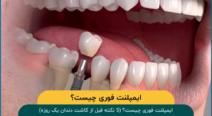 ایمپلنت فوری چیست؟