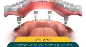 اوردنچر دندان