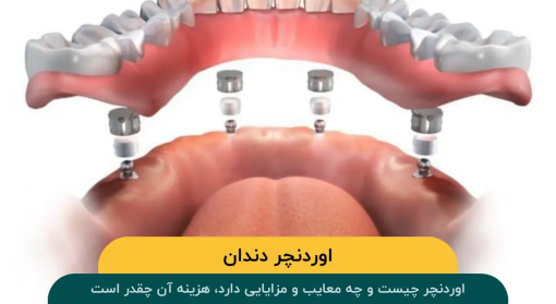 اوردنچر دندان