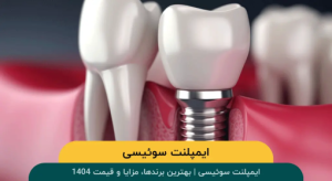 ایمپلنت سوئیسی | بهترین برندها، مزایا و قیمت 1404