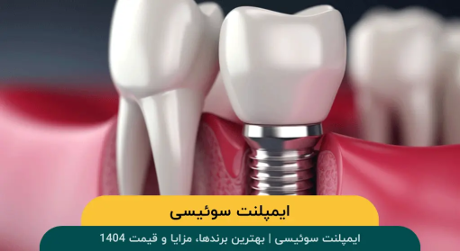 ایمپلنت سوئیسی | بهترین برندها، مزایا و قیمت 1404