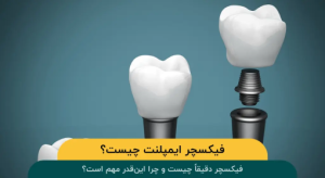 فیکسچر-ایمپلنت