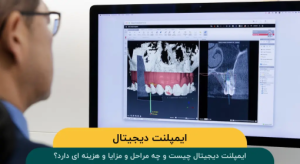 ایمپلنت دیجیتال