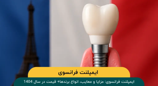 ایمپلنت فرانسوی