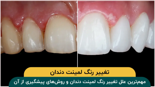 مهم‌ترین علل تغییر رنگ لمینت دندان و روش‌های پیشگیری از آن