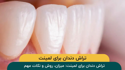 تراش دندان برای لمینت: میزان، روش و نکات مهم