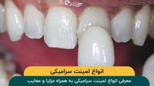 مزایای لمینت سرامیکی: معرفی، انواع، قیمت و عکس