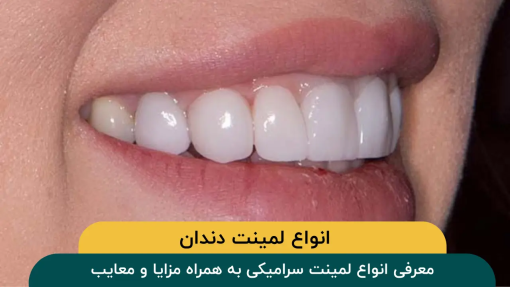انواع لمینت دندان + مزایا و معایب هر نوع
