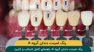 رنگ لمینت دندان گروه A: راهنمای کامل انتخاب و کاربرد