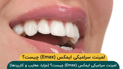 لمینت سرامیکی ایمکس (Emax) چیست؟ (مزایا، معایب و کاربردها)