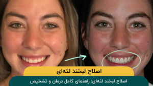 اصلاح-لبخند-لثه-ای