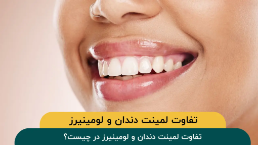 تفاوت لمینت دندان و لومینیرز در چیست؟