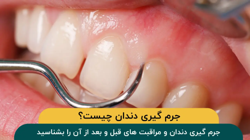 جرم گیری دندان چیست و چگونه انجام می شود؟