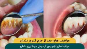مراقبتهای لازم پس از درمان جرمگیری دندان