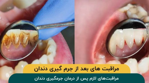 مراقبت‌های لازم پس از درمان جرمگیری دندان