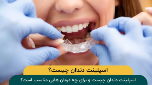 اسپلینت-دندان-چیست؟